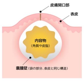 粉瘤とは