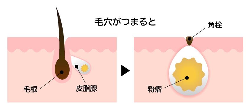 粉瘤の種類と原因