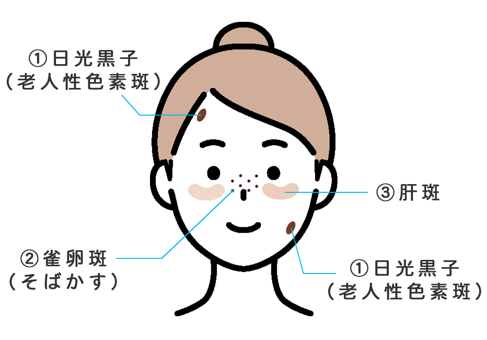 おでこの濃いシミ、肝斑、そばかす、頬の濃いシミ